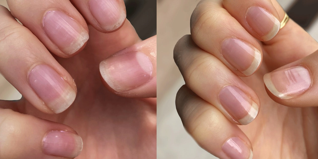 How to recover from damaged nails after acrylics or gel